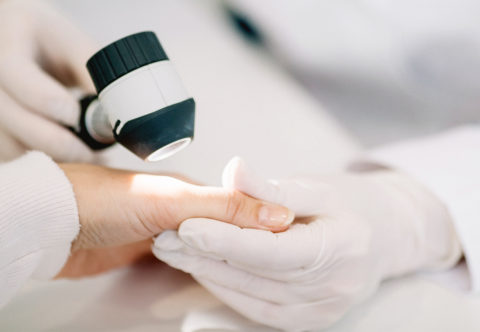 Dermatologička mi našla nebezpečné znamienko. Čo s tým a ako na prevenciu?