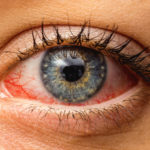 Keď sú oči červené a pália: Čo robiť so zápalom spojiviek?